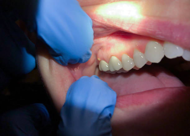 Best Walk-In Emergency Dentist in Prces Lakes, IN